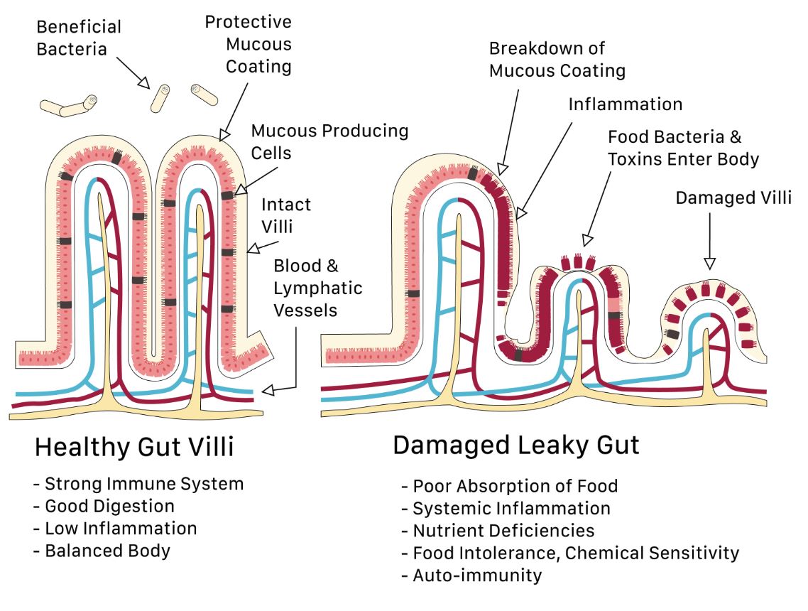 Leaky gut