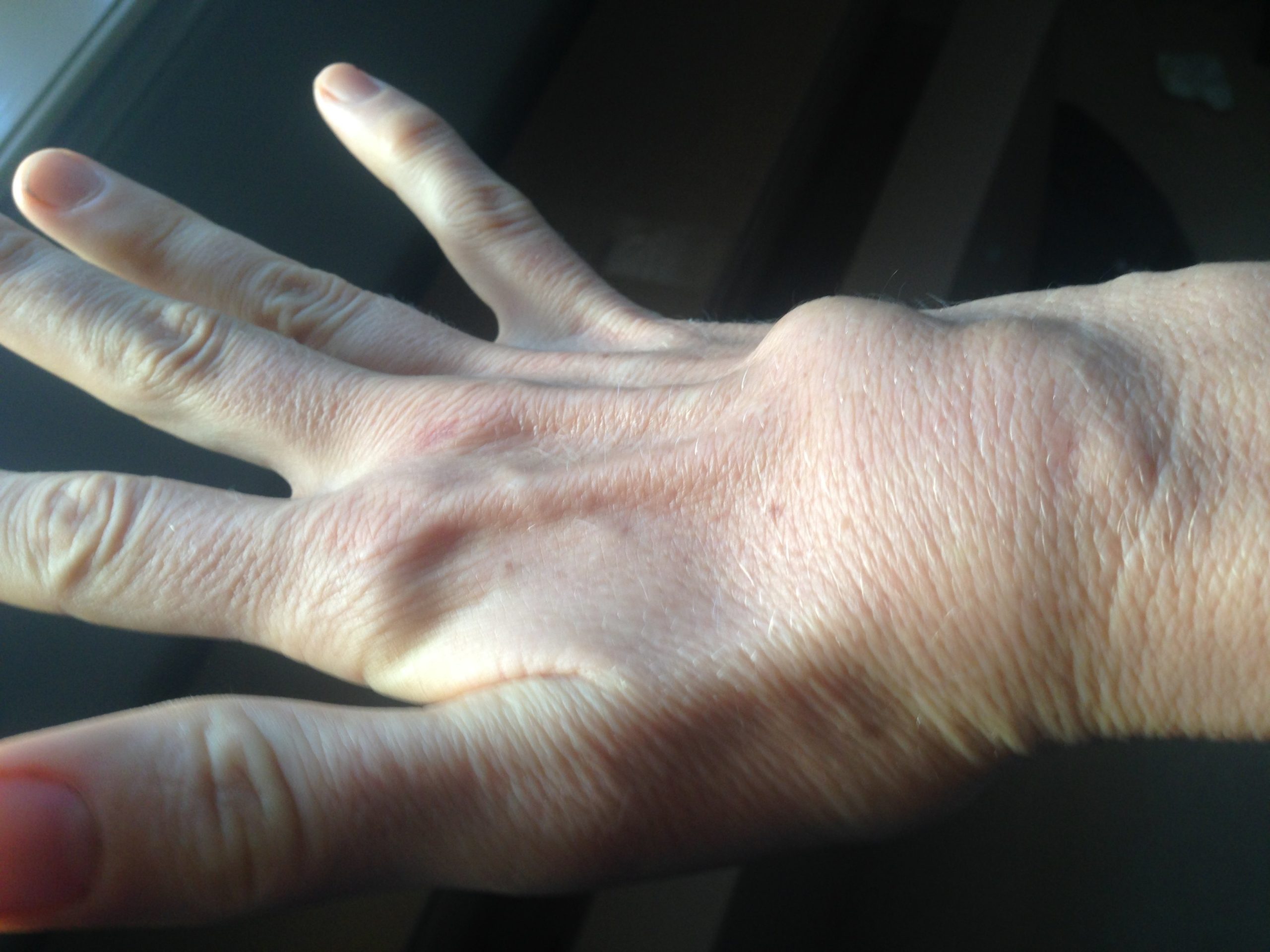 Rheumatoid arthritis wrist